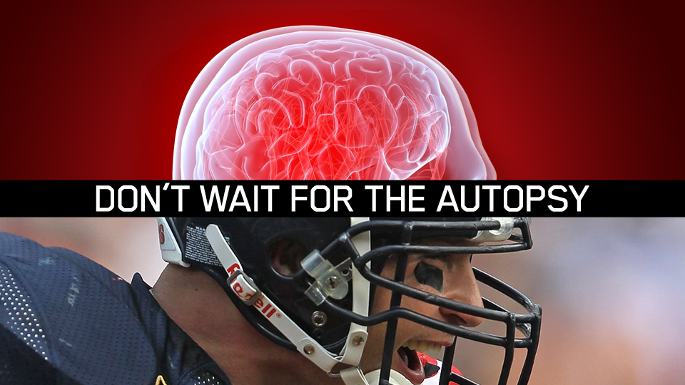 Progressive Brain Disease CTE Confirmed as Unique Disease