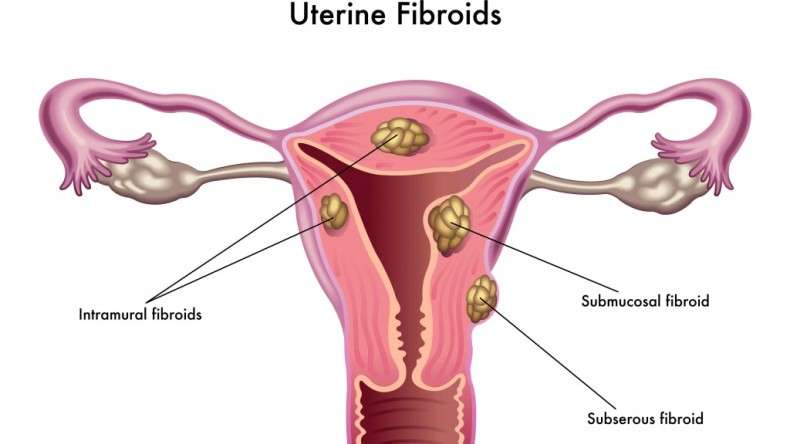 Dwarf Woman Undergoes Complex Surgery for Fibroid Uterus