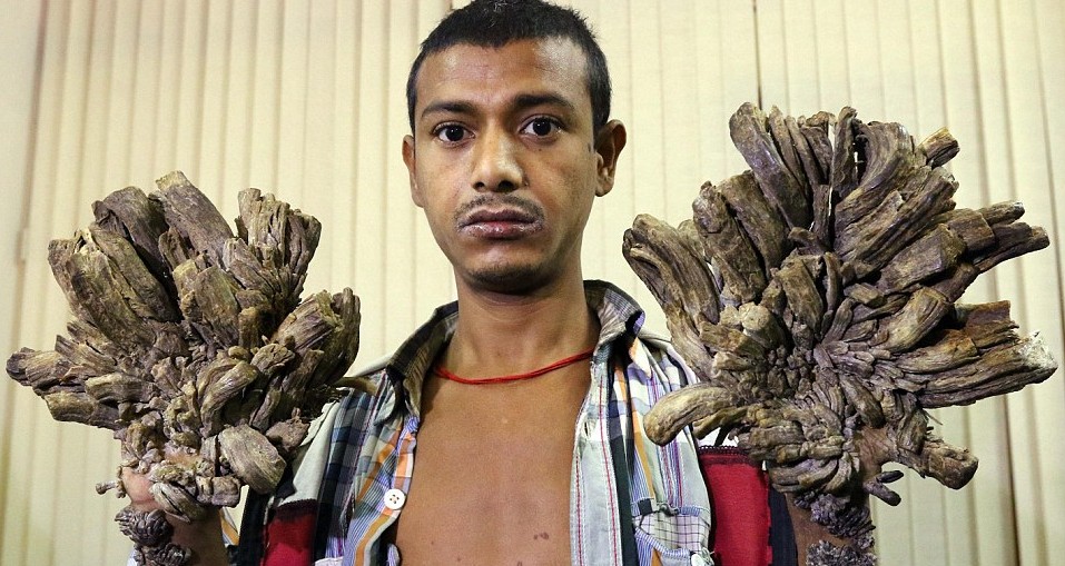 Bangladesh 'Tree Man' hopes to return to work after operation