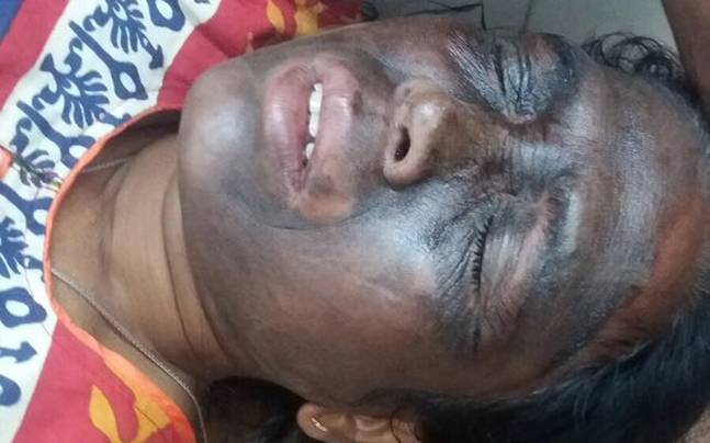 Acid attack victim Adivasi leader to be brought to Delhi
