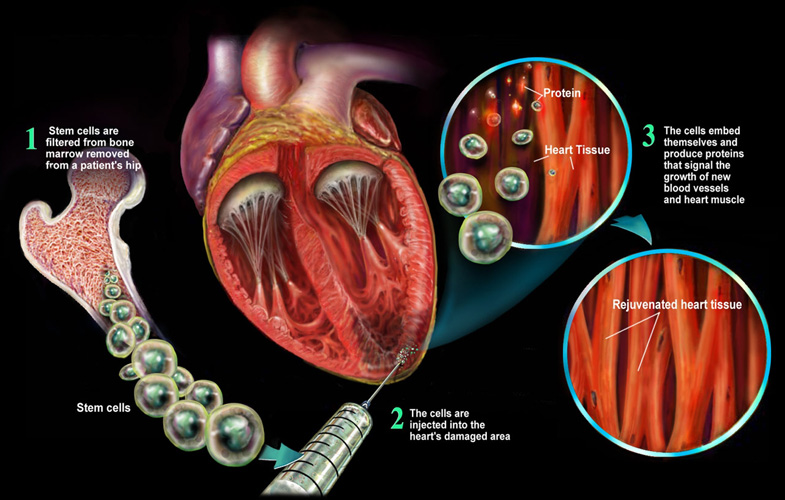 New insight into cardiac stem cell therapies
