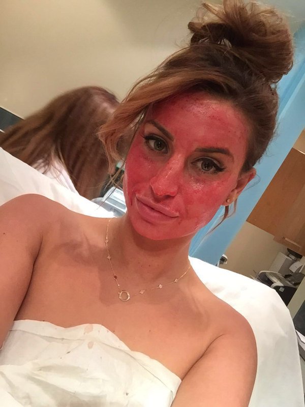 Ferne McCann's Vampire Facial