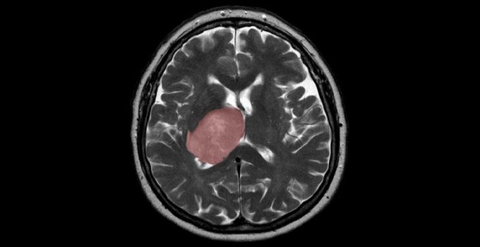 Brain cancer linked to tissue healing: Researchers Brain cancer linked to tissue healing: Researchers