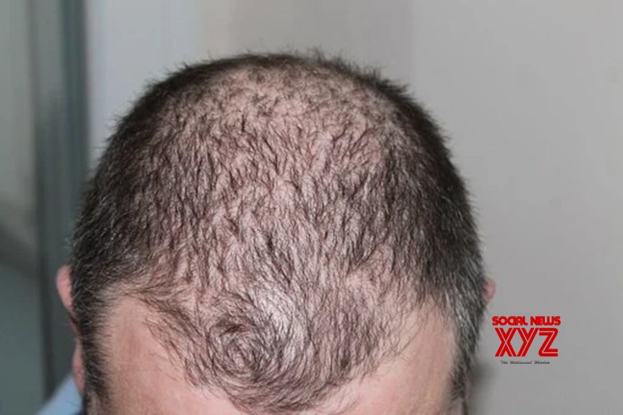 Hair loss, low sex drive among long Covid symptoms: Study Hair loss, low sex drive among long Covid symptoms: Study