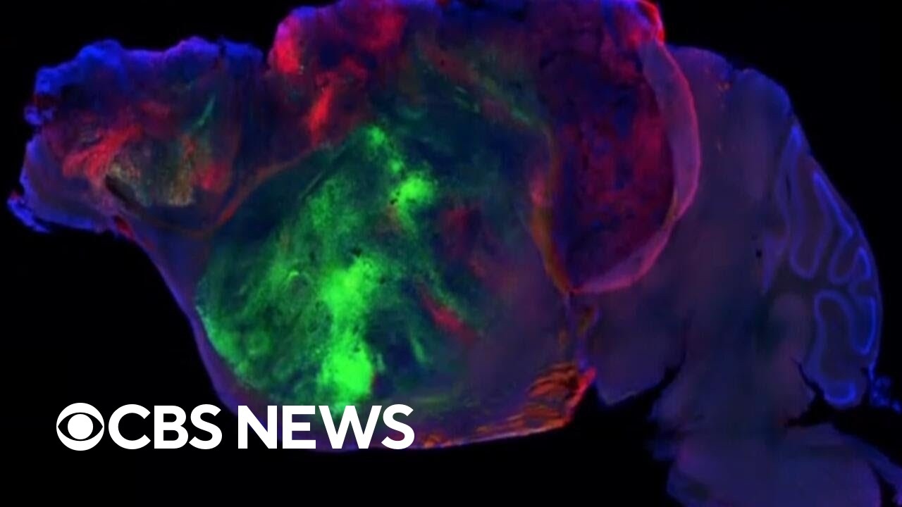 Neuroscientist explains how his team grew human brain tissue in mice and breaks down what they found (Video) Neuroscientist explains how his team grew human brain tissue in mice and breaks down what they found (Video)