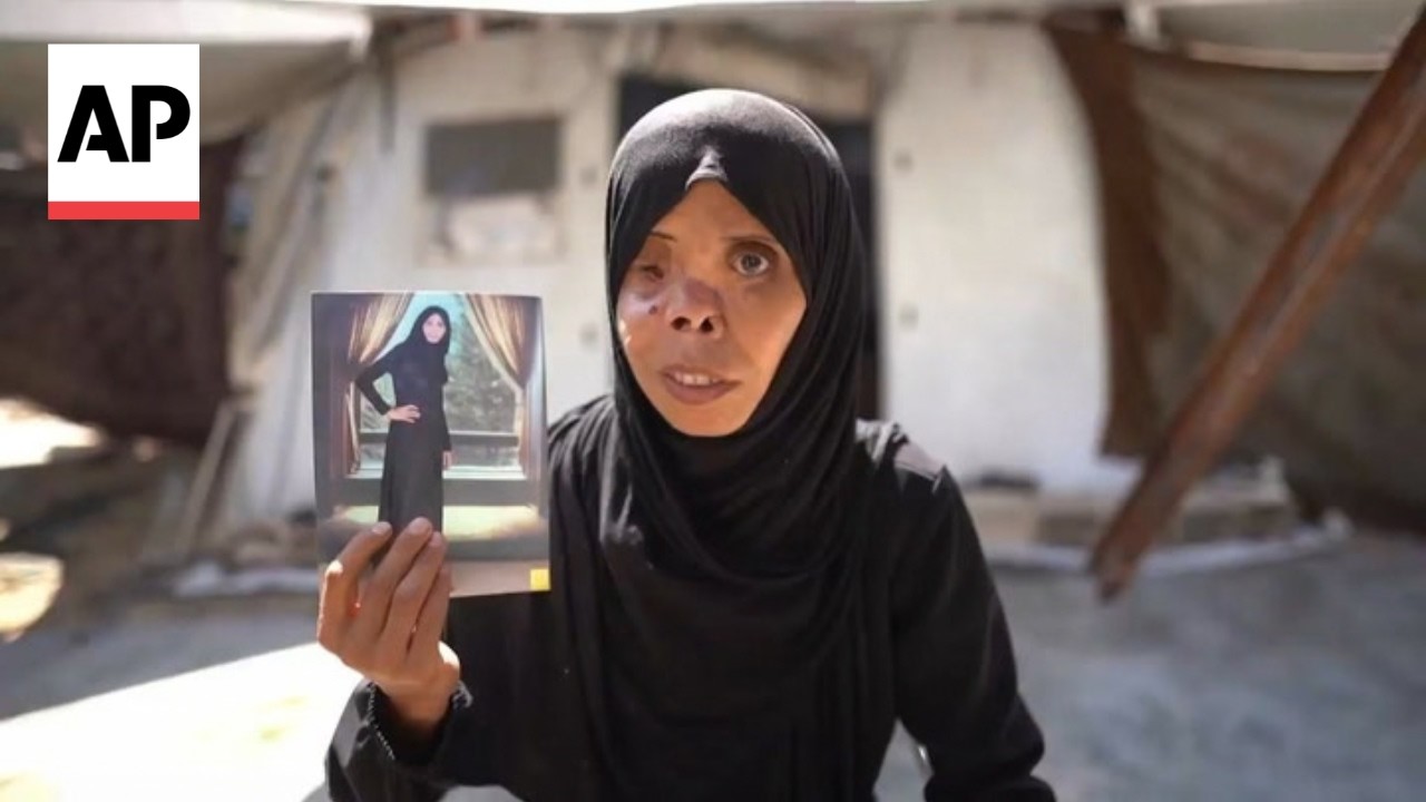 How life-changing war injuries transformed the everyday lives of people in Gaza (Video)