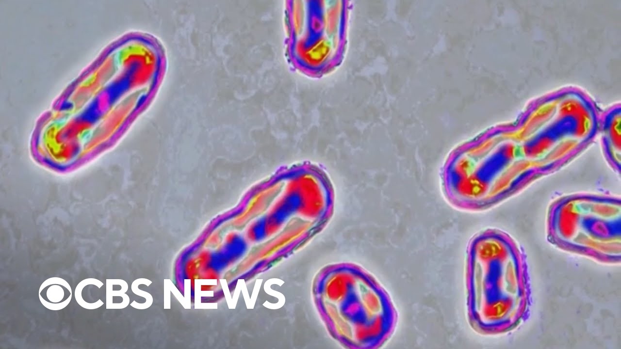 Medical experts on plague risks after reported death of lab worker in Russia (Video)
